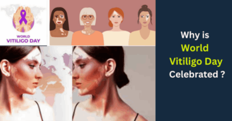 World Vitiligo Day